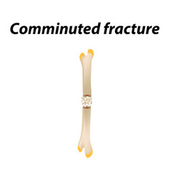 Comminuted Fracture Bone Infographics