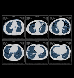 Covid-19 Computed Tomography Of The Lungs Ct Scan