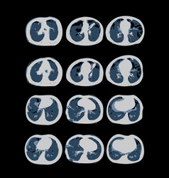 Covid-19 Computed Tomography Of The Lungs Ct Scan