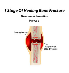 1 Stage Of Healing Bone Fracture Formation