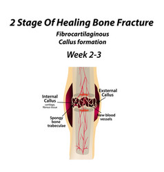 2 Stage Of Healing Bone Fracture Formation