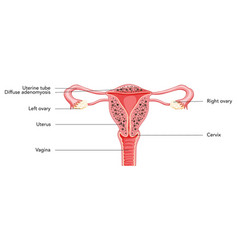 Diffuse Adenomyosis With Inscriptions Human