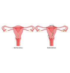 Endometriosis Female Reproductive System Normal