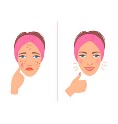 Acne Treatment Before After Cartoon