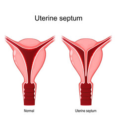 Uterine Septum