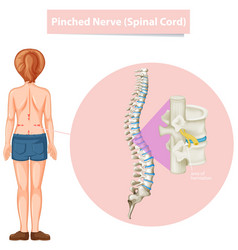 Diagram Showing Pinched Nerve