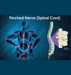 Diagram Showing Pinched Nerve On Human