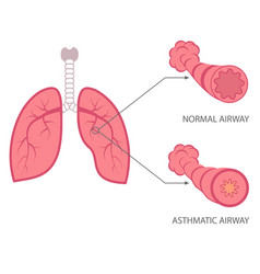 Asthma Lungs Respiratory Disease