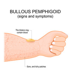 Bullous Pemphigoid Autoimmune Pruritic Skin