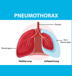 Pneumothorax Diagram With Collapsed Lung