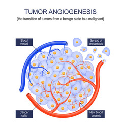 Tumor Angiogenesis