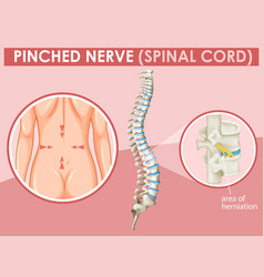 Diagram Showing Pinched Nerve In Human