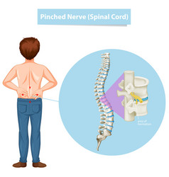 Diagram Showing Man And Pinched Nerve