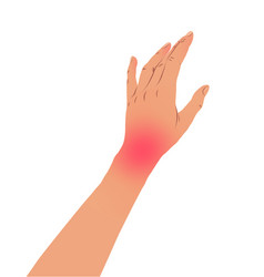 Left Hand With Carpal Tunnel Syndrome