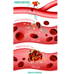 Hemophilia infographics poster Royalty Free Vector Image