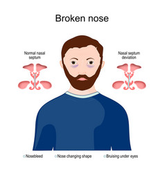 Symptoms Of A Broken Nose