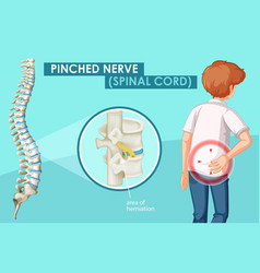 Diagram Showing Pinched Nerve