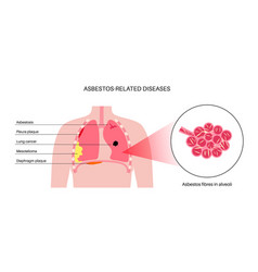 Asbestos Related Diseases