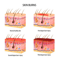 Realistic Skin Burn Classification