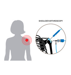 Shoulder Arthroscopy Poster