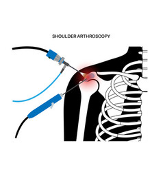 Shoulder Arthroscopy Poster