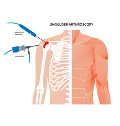 Shoulder Arthroscopy Poster