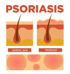 Psoriasis And Normal Skin Layers Detailed