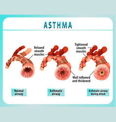 Bronchial Asthma Diagram With Normal Airway