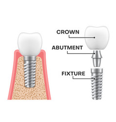 Dental Implant Structure Realistic Schematic