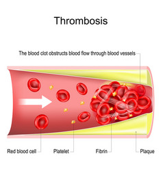 Thrombosis The Blood Clot Obstructs Blood Flow