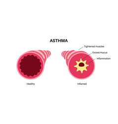 Asthma Lung Disease