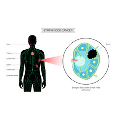 Lymphoma Cancer Concept