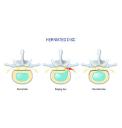 Difference Between Bulging Disc And Herniated Disc