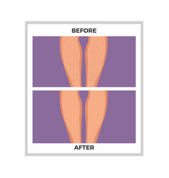 Flat Hair Removal