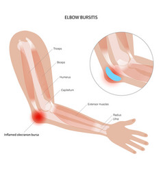 Student Elbow Bursitis