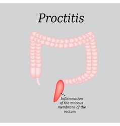 Colon Proctitis On A Gray