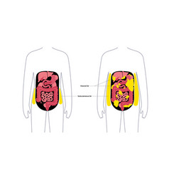 Visceral Fat Diagram