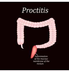 Colon Proctitis On A Black