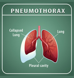 Pneumothorax Diagram With Collapsed Lung