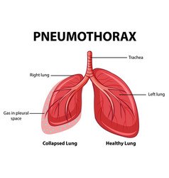 Pneumothorax Diagram With Collapsed Lung