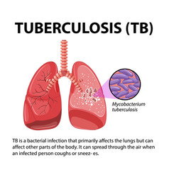 Human Anatomy Of Lung With Tuberculosis