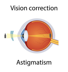 Vision Correction Of Astigmatism