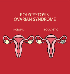 Polycystic Ovarian Syndrome Vs Normal