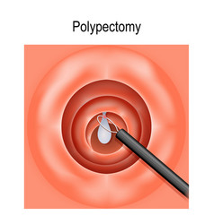 Colorectal Polyp And Polypectomy