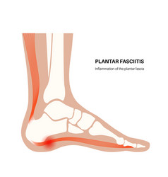 Plantar Fasciitis Concept