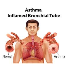 Human Anatomy Asthma Inflamed Bronchial Tube