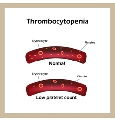 Thrombocytopenia Reduced Levels Of Thrombocytes