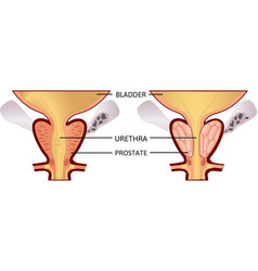 Benign Prostatic Hyperplasia Prostatitis