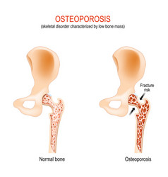 Osteoporosis Normal Hip Joint And Bone With Low