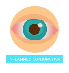 Inflamed Conjunctiva Conjuntivitis Sore Eye